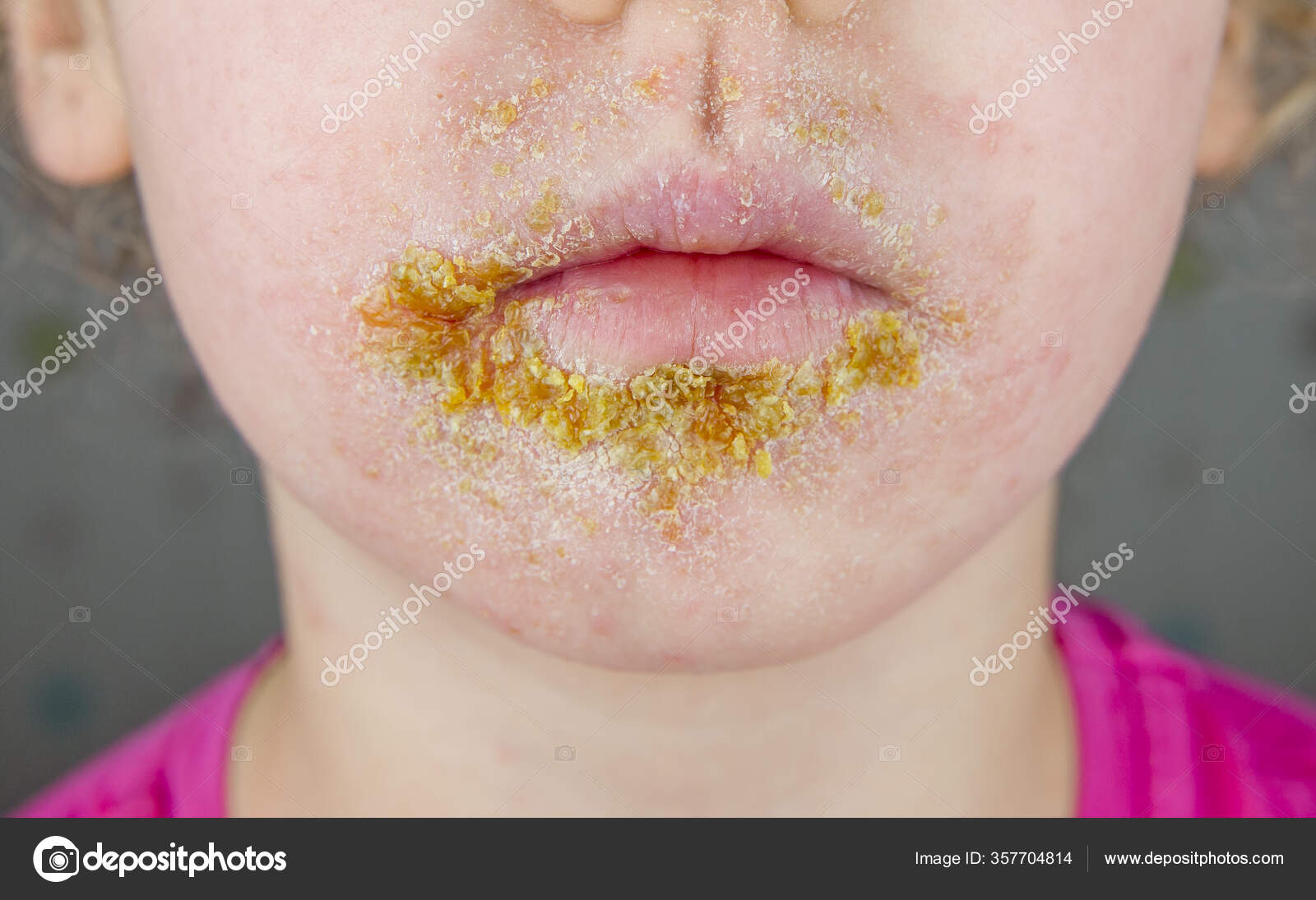 year old child impetigo nonbullous impetigo witch bacterial infection involves stock photo by c fotohelin 357704814
