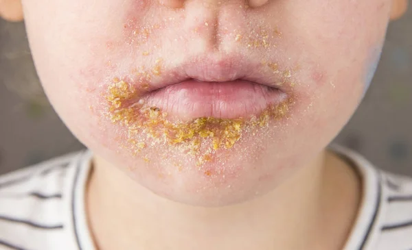 Gammalt Barn Med Impetigo Nonbullous Impetigo Häxa Bakteriell Infektion Som — Stockfoto