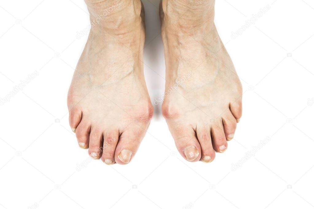 Medical condition called bunions(Hallux abducto valgus, hallux valgus, metatarsus primus varus)it is bump on the outside of the base of big toe. Close up view of 50 year old woman feet with bunions.