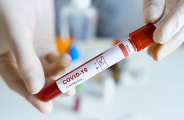 Yakın plan laboratuvar bilim adamı, COVID-19 analizi için üzerinde kan örneği olan test tüpünü tutan eldivenleri teslim etti. Coronavirüs veya covid-19 test sonuçları