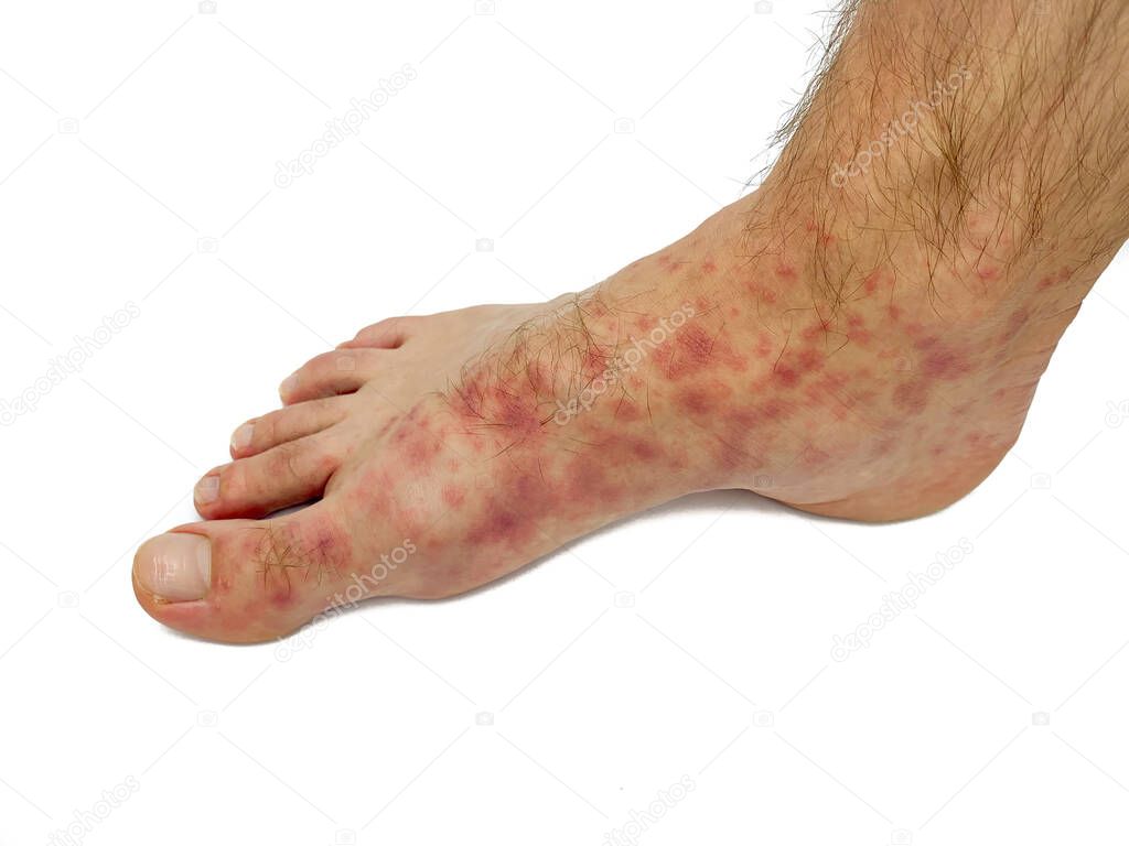 Red rash on the feet of a male. Stock image isolated on a white background.
