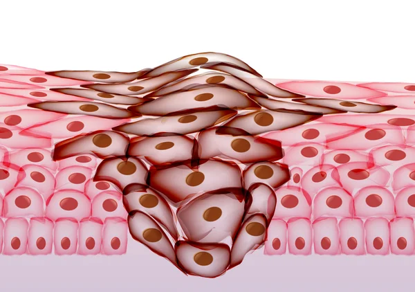 Tumore in crescita, Sezione Tessuti - Illustrazione Vettoriale — Vettoriale Stock