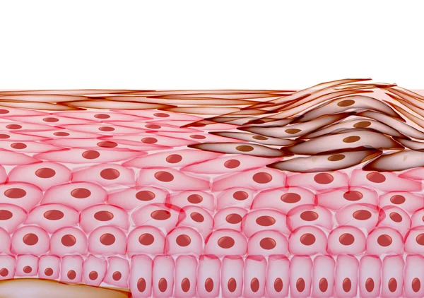 Melanoma en capas de la piel humana, Cáncer - Ilustración vectorial — Archivo Imágenes Vectoriales