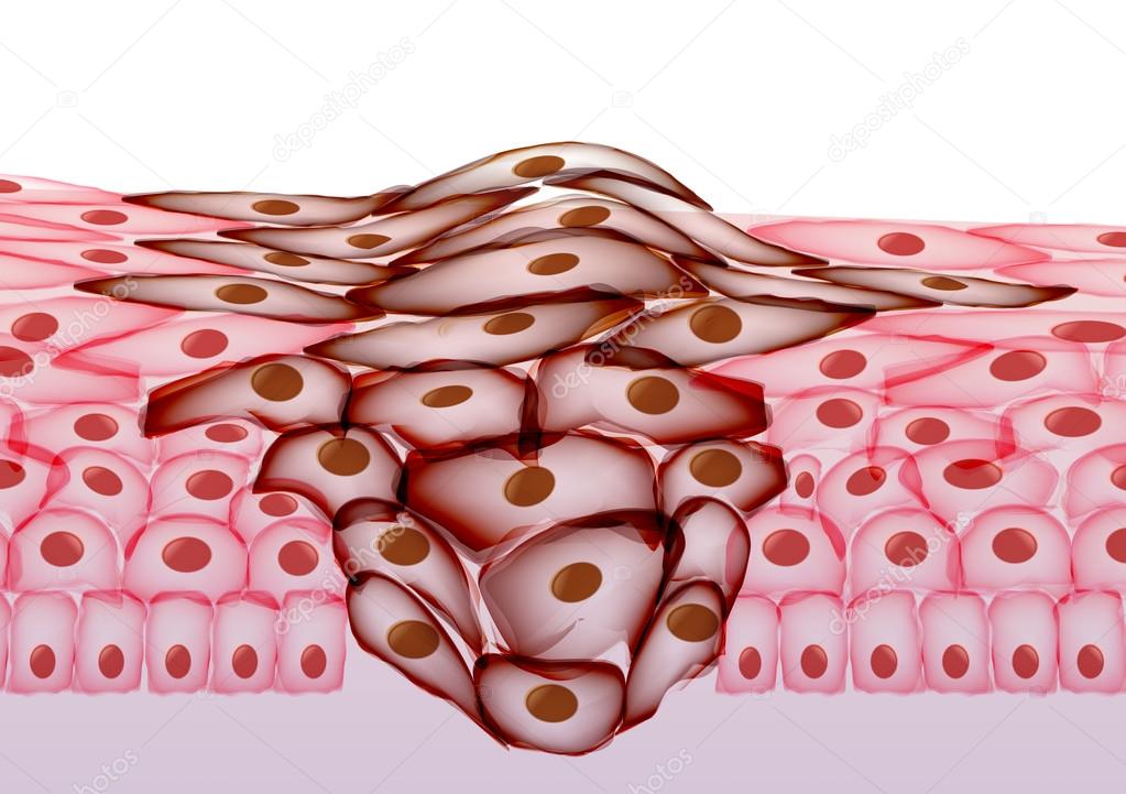 Growing Tumor, Tissue Section - Vector Illustration 