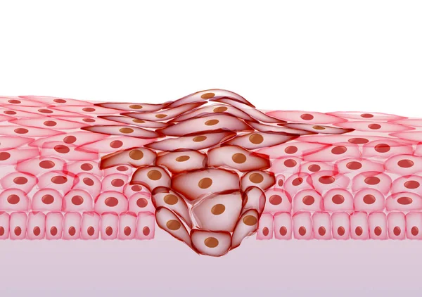 Büyüyen tümör, doku bölümü - vektör çizim