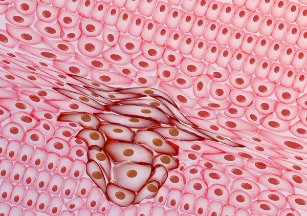 Growing Tumor, Tissue Section - Vector Illustration