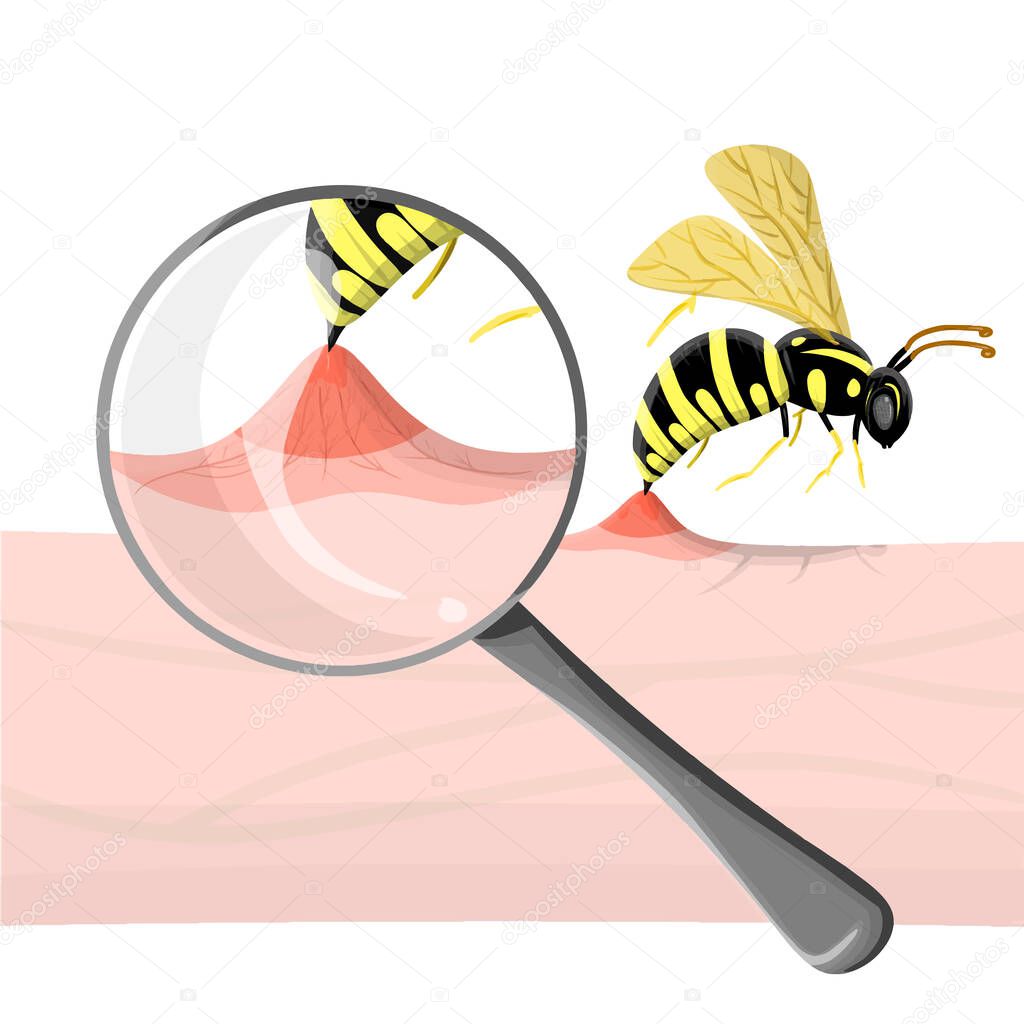 Wasp sting human. Close up detailed with magnifier pathogenesis of bee stings and allergic reaction. Vector illustration in cartoon relistic style. Medical poster, anaphylaxis, summer danger. insect