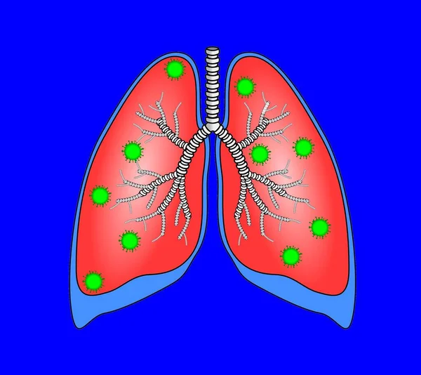 Illustration Eines Virus Der Lunge Symbol Einer Infektion Während Einer — Stockfoto