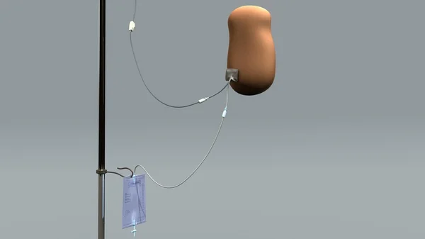 Bauchfell-Dialysegeräte. — Stockfoto