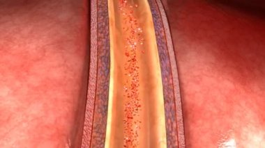 İnsan arter diseksiyonu