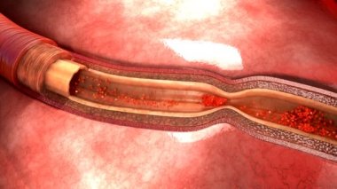 Koroner arter spazmı