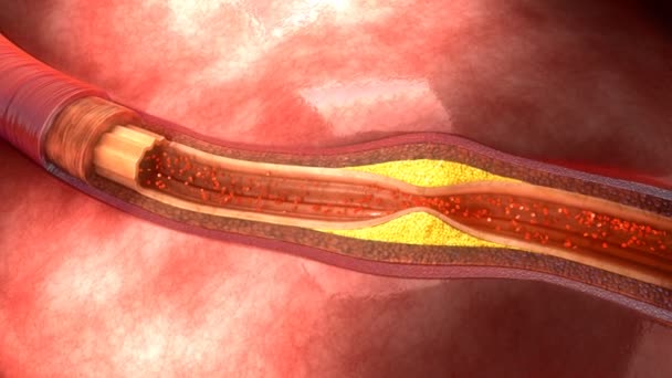 Aterosclerosis Arterial Humana — Vídeos de Stock