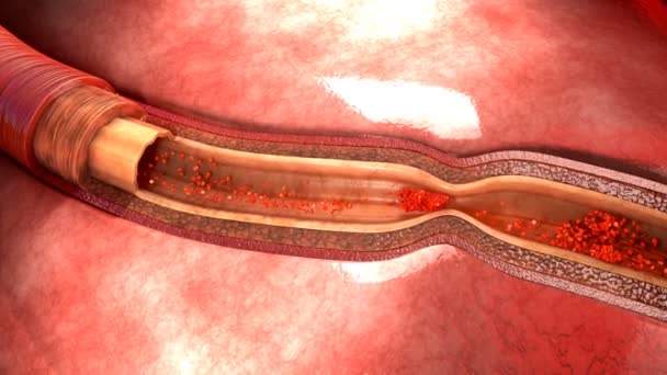 Coronary artery spasm — Stock Video