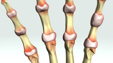 Romatoid artrit yakın çekim