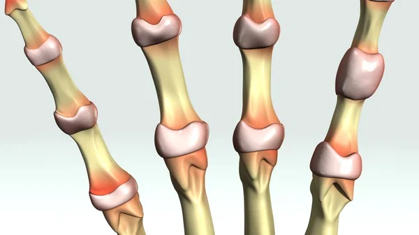 Reumatoidalne zapalenie stawów z bliska — Zdjęcie stockowe