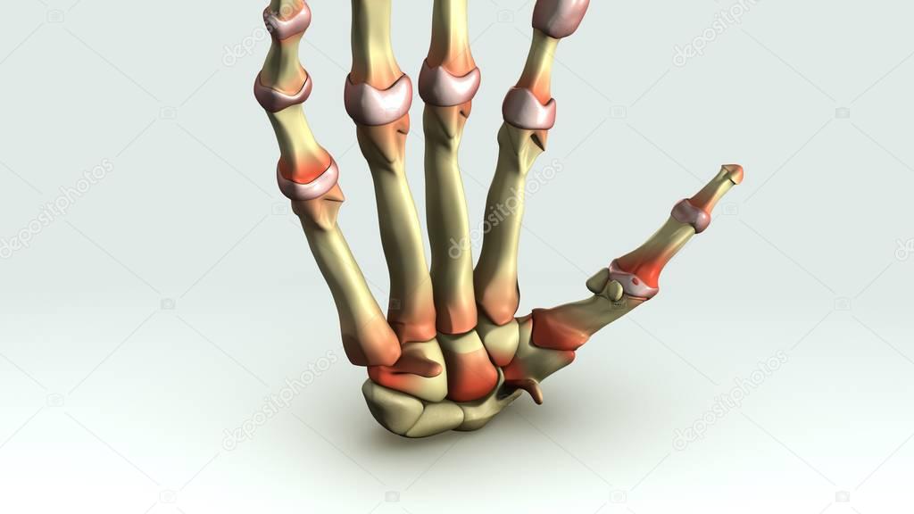 Rheumatoid arthritis close up