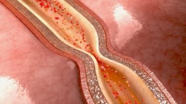 Koroner arter rahatlatıcı nitrogliserin