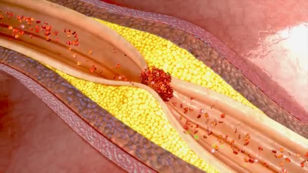 Thrombolytic therapy 3d — Stock Video