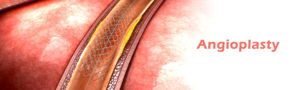 Коронарная ангиопластика
