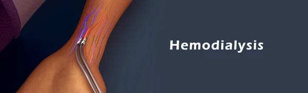 Hemodialyse, zuivering van het bloed — Stockfoto