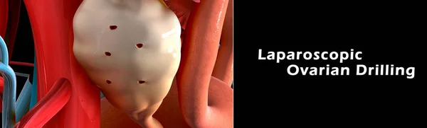 Laparoscopische ovariële boren — Stockfoto