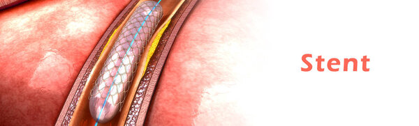 stent in human blood vessel