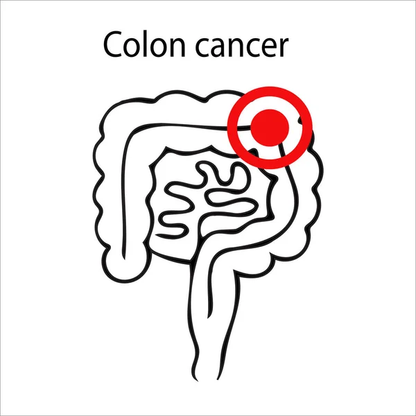 Vector Illustration Colon Cancer Hand Drawn Human Colon Isolated White — Stock Vector