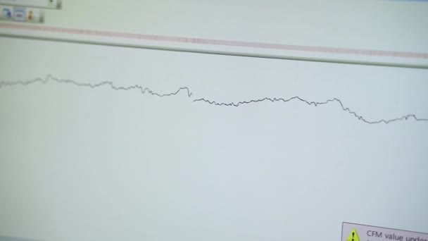 Gezicht Een Elektrocardiogram Monitor Een Bewegende Grafiek Van Hartslag Medische — Stockvideo