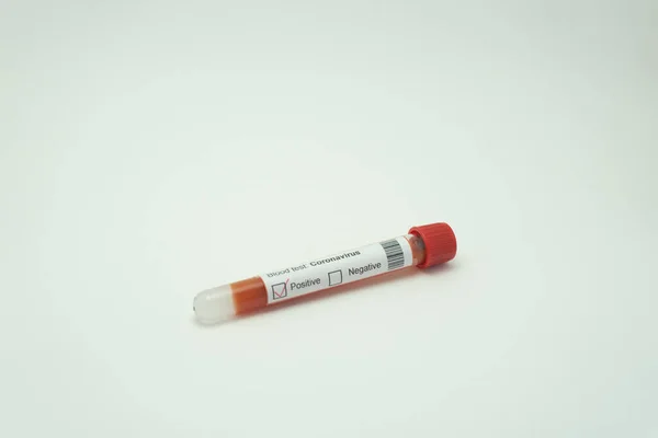 Coronavirus test tüpü. Kan testleri hastanın 2019-NcOv testinin pozitif çıktığını gösteriyor..