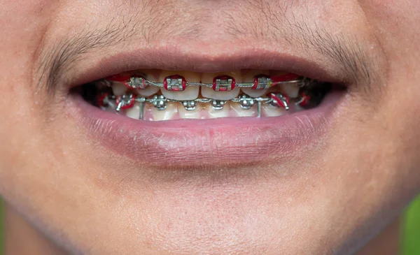 Close up the braces on teeth of an Asian boy.