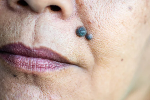 Nahaufnahme eines Maulwurfs auf dem Gesicht der alten Frau. — Stockfoto