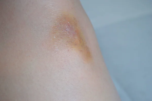 Mulher Aplicando Creme Nos Joelhos Machucados Hematomas Joelho Fundo Leve — Fotografia de Stock