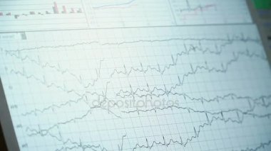 Genel olarak istasyonu monitör yoğun bakım ünitesinde hemşireler. EKG monitör ekran.