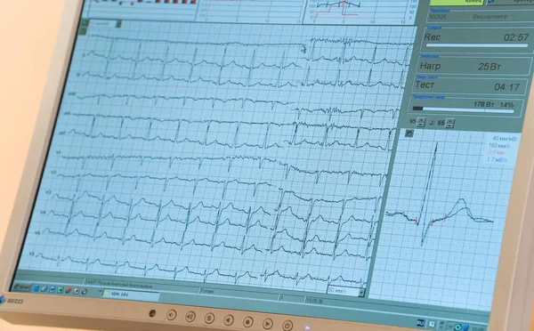 Overall nurses station monitor in the intensive care unit. ECG monitor screen.