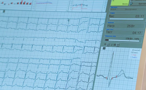 Overall nurses station monitor in the intensive care unit. ECG monitor screen.