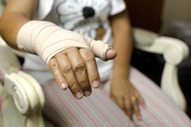 Elinde kemik kırık tahta ile bir sandalyede oturan kadın