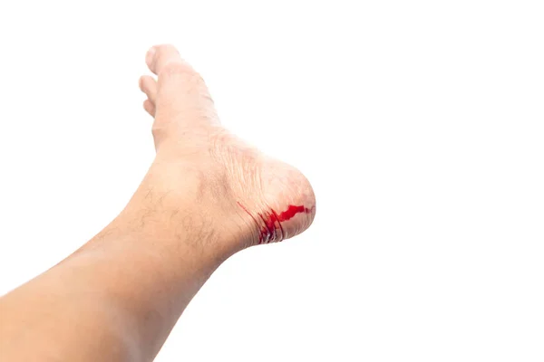 Lesión en los pies rompiendo la piel con sangre sangrando recorte aislado — Foto de Stock