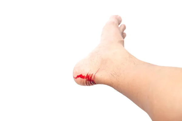 Uraz Nogi Łamiąc Skóry Krwawieniem Krwi Białym Tle Tle Ścieżki — Zdjęcie stockowe