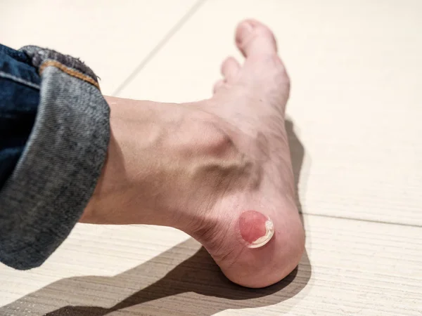 Big bloody callus on man's heel