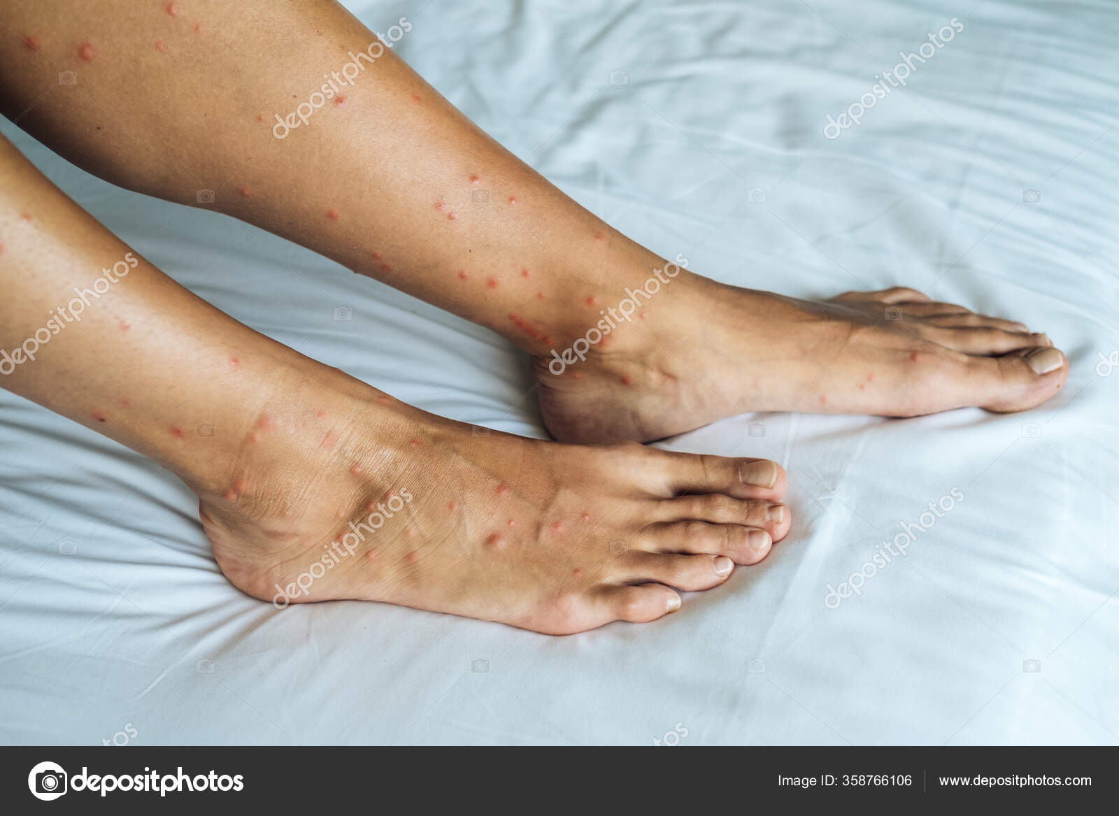 Premium Photo  Female legs with many red spot and scar from sand fly bites