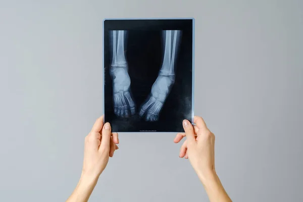 新生児の足のX線画像を調べる女性医師 灰色の背景に隔離された — ストック写真