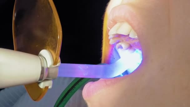 La donna ottiene l'aiuto dentale per riempire una carie in un dente — Video Stock