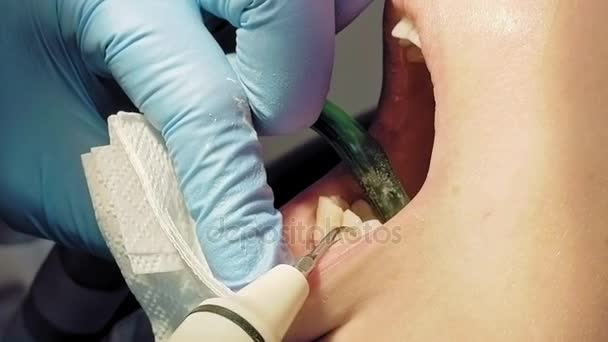 Femme plaque dentaire à ultrasons odontolith enlèvement — Video