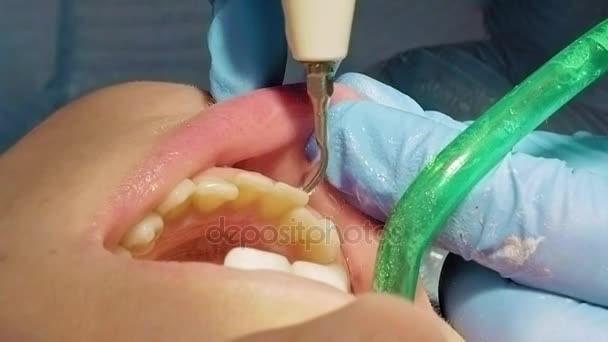 Donna ultrasuoni dente placca odontolith rimozione — Video Stock