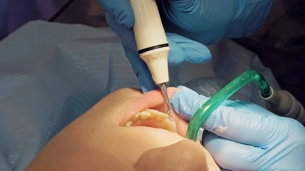 Woman ultrasonic tooth plaque odontolith removing — Stock Photo, Image