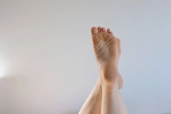 foot with rough skin and a dry heel with many cracks. The concept of health problems, poor self-care. Monitor feet skin condition to prevent skin breakdown and trauma.