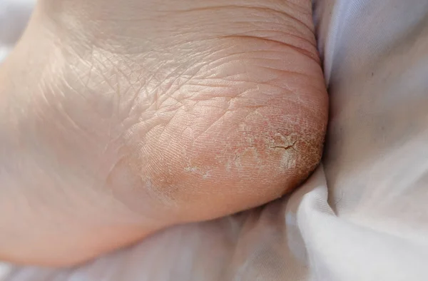 The Heel Of The Foot With Bad Skin Is Covered With Cracks. White Background. Pain. Monitor feet skin condition to prevent skin breakdown and trauma.