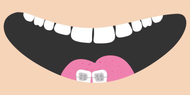 Gülen sevimli çizgi film suratı. Dişli, diş telli ve dilli bir ağız. Sağlıklı diş teli. Vücut parçası. Ağız temizliği çocukların diş bakımı ikonu. Düz tasarım bej renkli arkaplanda izole edildi.