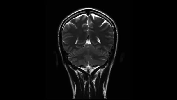 Beyin Kesişiminin Bilgisayarlı Tomografisi Siyah Arkaplan Tıp Bilimi Teknoloji Kavramına — Stok video