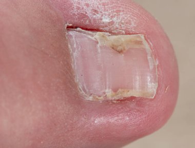 Ameliyat sonrası iyileşmekte olan eski bir ayak tırnağı. Cerrahi işlemden bu yana aylar geçti ve ayak parmağında artık bakteri ya da mantar enfeksiyonu yok. Tırnak yatağı ile ayak parmağı arasındaki büyük boşluklar hala duruyor.